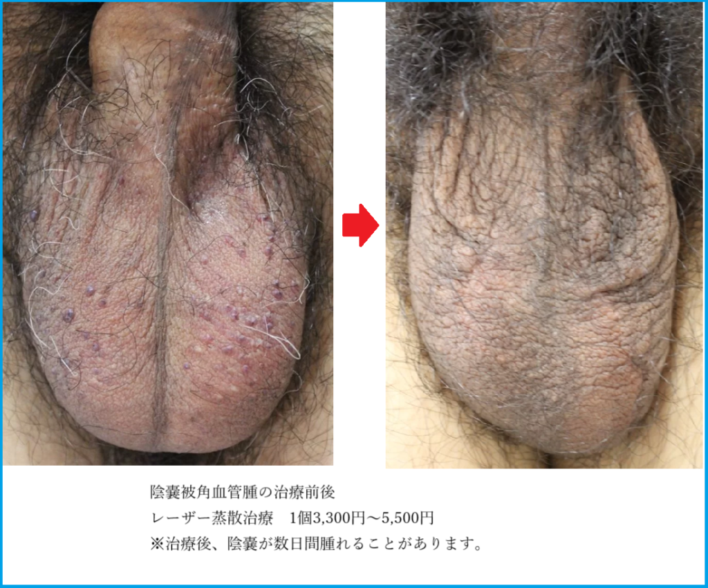 陰嚢被角血管腫の治療前後