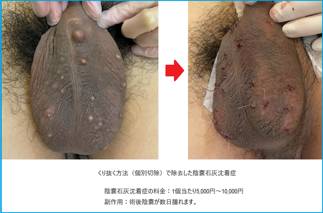 陰嚢石灰沈着症の治療前後