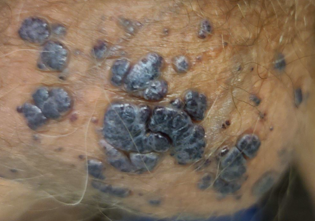 陰嚢被角血管腫たくさんできた例