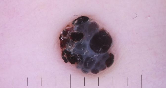 陰嚢被角血管腫の拡大