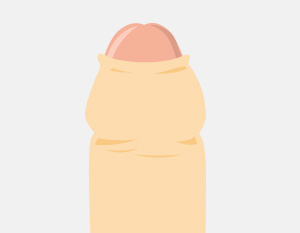 仮性包茎イラスト