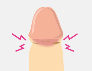 カントン包茎イラスト