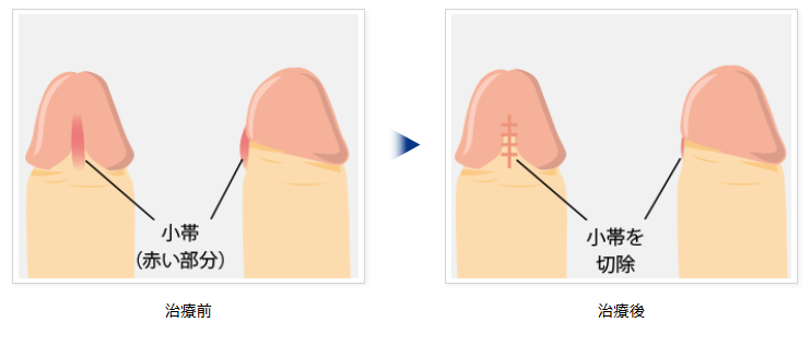 小帯切除術のイラスト