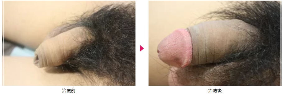 仮性包茎の症例写真