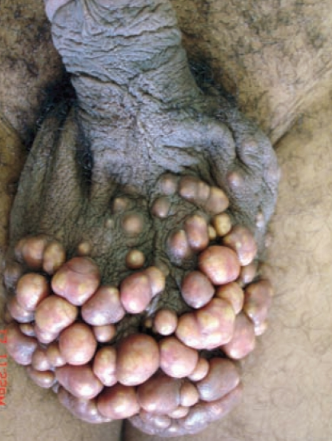 玉袋（金玉）の白いブツブツ：陰嚢石灰沈着症はなぜなるの？発生機序や要因